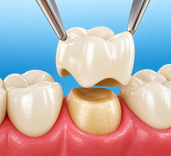 Dental-Crowns