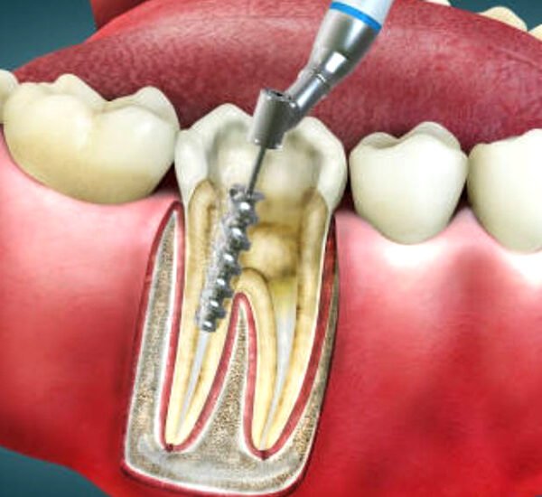 Root-canal