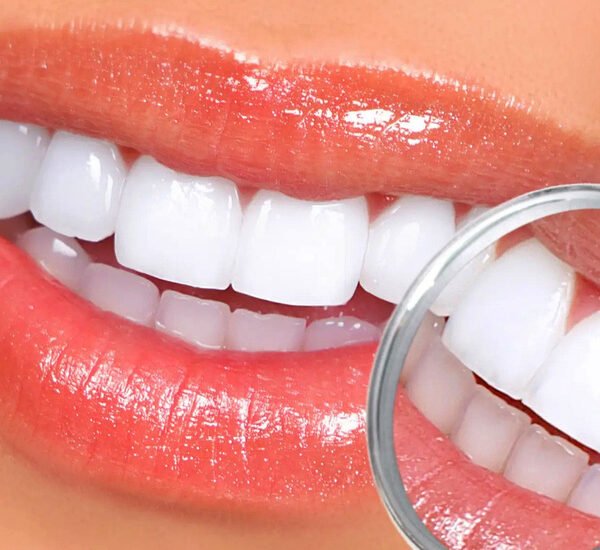 Teeth-Whitening