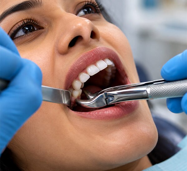Tooth-Extraction